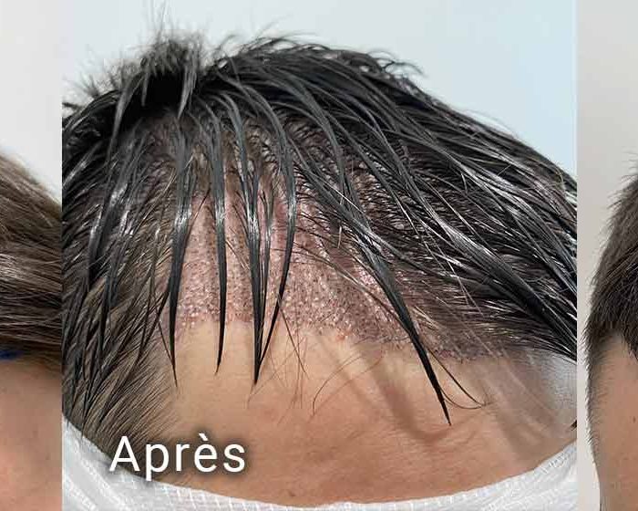 Implant Capillaire Resultats Avant Apres De La Procedure Artas Par The Clinic