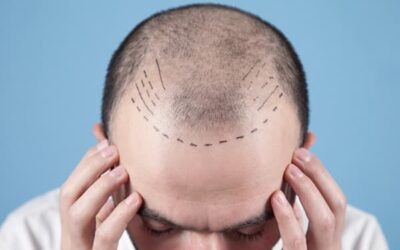 Calvitie Vs pelade : comment les différencier ?