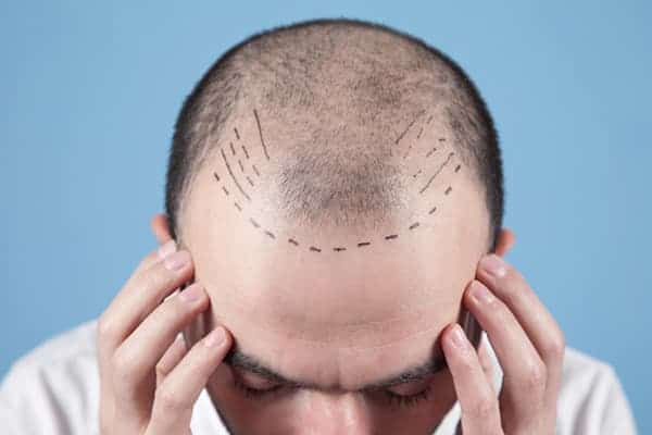 alopecie androgenetique homme clinique greffe de cheveux paris implants capillaires greffe de cheveux the clinic paris