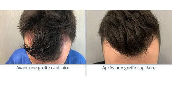 avant apres u greffe de cheveux clinique implants artas greffons greffe capillaires avant apres the clinic paris