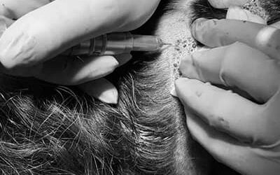 Greffe de cheveux : est-ce douloureux ?