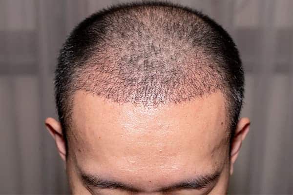 calvitie alopecie androgenetique homme clinique greffe de cheveux paris implants capillaires greffe de cheveux the clinic paris