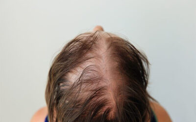 Femme & Chute de cheveux : de quoi souffre Jada Pinkett-Smith ?