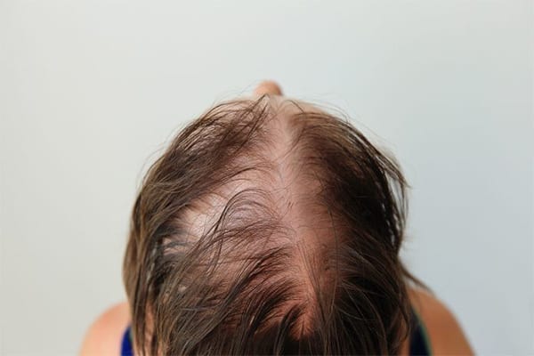 calvitie femme que faire alopecie androgenetique grosse perte de cheveux clinique greffe de cheveux robotisee paris implants capillaires greffe de cheveux the clinic paris