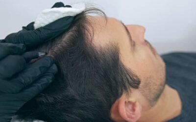 Quel est mon stade de calvitie ?