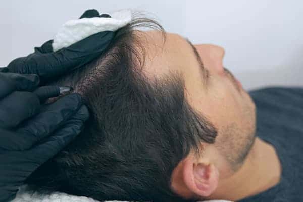 calvitie homme que faire alopecie androgenetique grosse perte de cheveux clinique greffe de cheveux robotisee paris implants capillaires greffe de cheveux the clinic paris