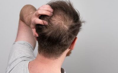 La greffe de cheveux : l’essentiel en 5 points