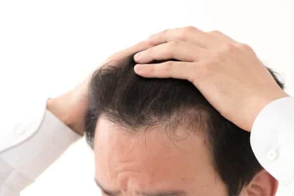 causes alopecie androgenetique perte de cheveux symptomes clinique greffe de cheveux robotisee paris implants capillaires greffe de cheveux the clinic paris