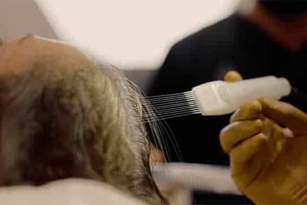 formation o injection peptides greffe capillaire clinique implant capillaire greffe de cheveux the clinic paris