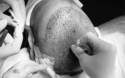 GREFFE de CHEVEUX : Faut-il opter pour une « FUE » ou pour une « FUT » ?