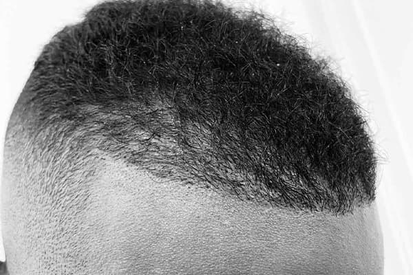 greffe de cheveux afro avant apres fue punch hybride clinique implant capillaire greffe de cheveux the clinic paris