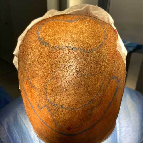 greffe de cheveux afro c fue punch hybride clinique implant capillaire greffe de cheveux the clinic paris