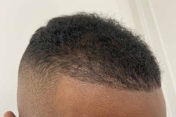 greffe de cheveux afro e fue punch hybride clinique implant capillaire greffe de cheveux the clinic paris
