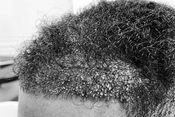 greffe de cheveux afro f fue punch hybride clinique implant capillaire greffe de cheveux the clinic paris