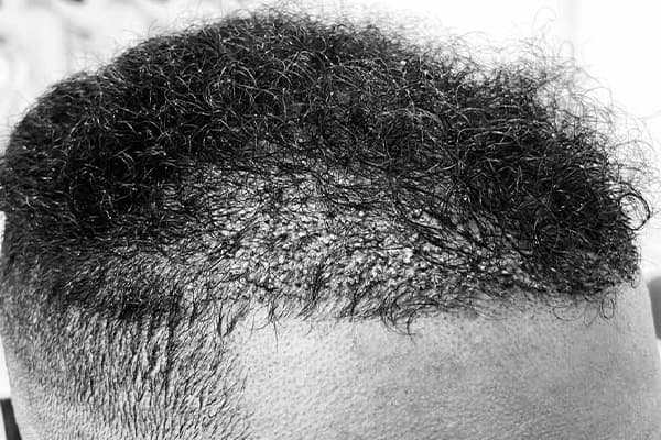 greffe de cheveux afro g fue punch hybride clinique implant capillaire greffe de cheveux the clinic paris