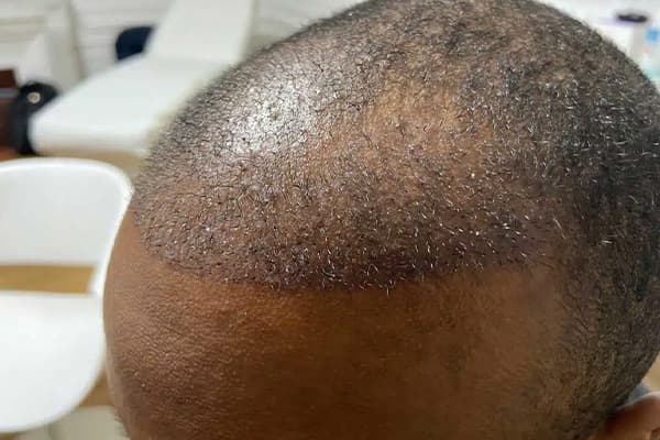 greffe de cheveux afro g resultats fue punch hybride clinique implant capillaire greffe de cheveux the clinic paris