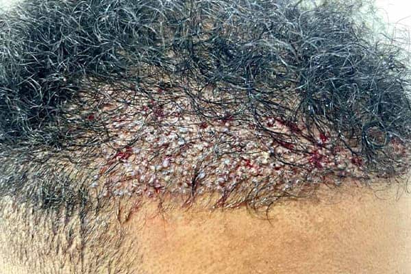 greffe de cheveux afro h fue punch hybride clinique implant capillaire greffe de cheveux the clinic paris