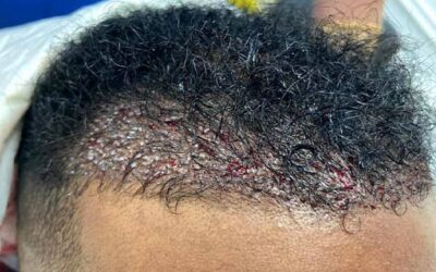 Greffe de cheveux sur cheveux afro : FUT ou FUE ?