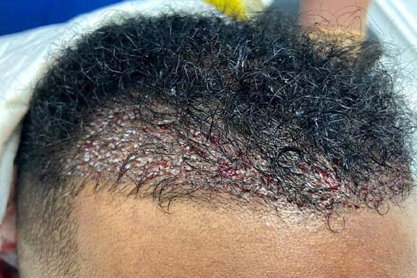 greffe de cheveux afro i fue punch hybride clinique implant capillaire greffe de cheveux the clinic paris