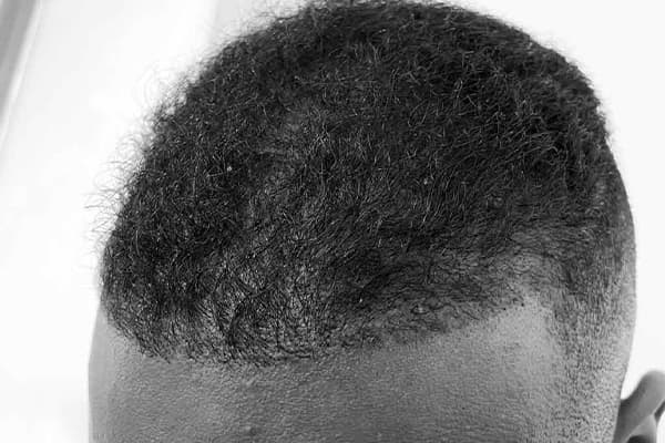 greffe de cheveux afro photos fue punch hybride clinique implant capillaire greffe de cheveux the clinic paris