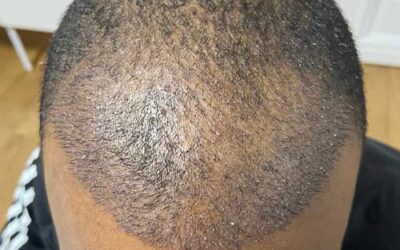 Le Punch Hybride ® : l’art de la greffe FUE sur cheveux afro/frisés
