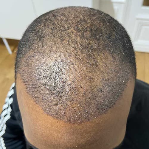 greffe de cheveux afro resultats fue punch hybride clinique implant capillaire greffe de cheveux the clinic paris