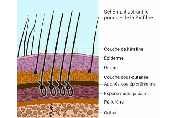 greffe de cheveux biofibre alopecie androgenetique cicatricielle grosse perte de cheveux clinique greffe de cheveux robotisee paris implants capillaires greffe de cheveux the clinic paris
