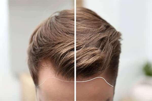 greffe de cheveux risques a l etranger danger alopecie androgenetique femme homme clinique greffe de cheveux implants capillaires the clinic paris