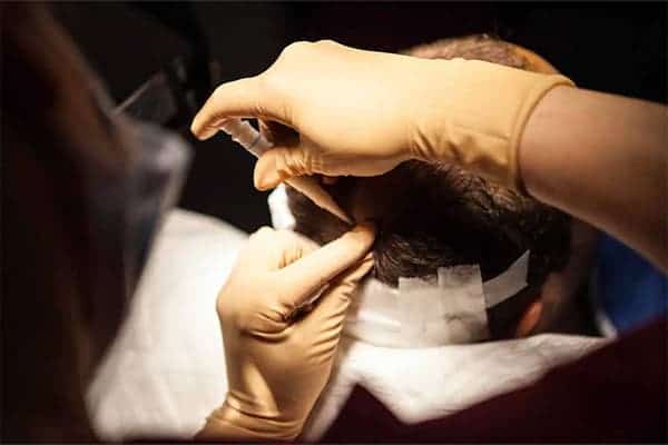 greffe de cheveux robot artas k clinique implants greffons capillaires greffe de cheveux the clinic paris