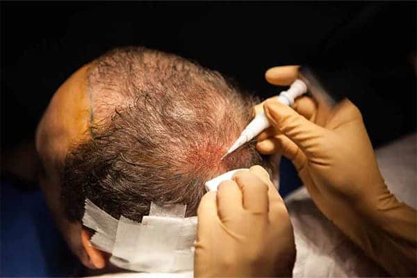 greffe de cheveux robot artas o clinique implants greffons capillaires greffe de cheveux the clinic paris