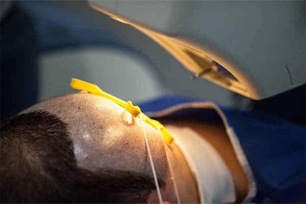 greffe de cheveux robotisee robot artas implantation capillaire clinique greffe de cheveux avant apres implants capillaires the clinic paris