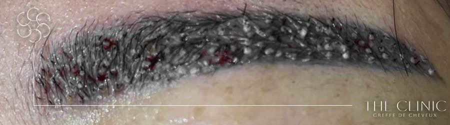 greffe sourcils avant apres prix clinique greffe de sourcils paris implants capillaires greffe de cheveux the clinic paris greffe sourcils avant apres prix clinique greffe de sourcils paris implants capillaires greffe de cheveux the clinic paris