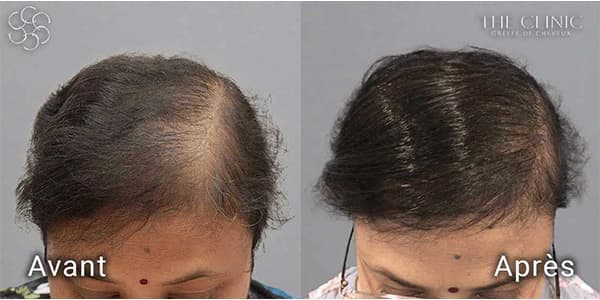 hairstetics by the clinic implants capillaires synthetique derrière generation avant apres a alopecie androgenetique femme clinique implants capillaires greffe de cheveux the clinic paris