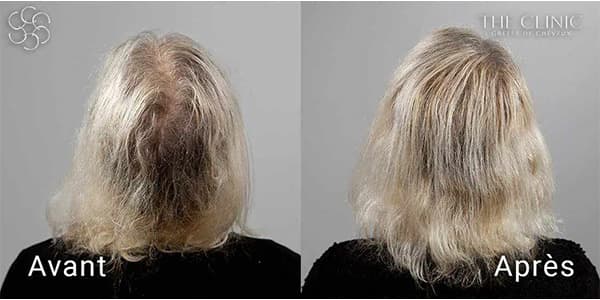 hairstetics by the clinic implants capillaires synthetique derrière generation avant apres e alopecie androgenetique femme clinique implants capillaires greffe de cheveux the clinic paris