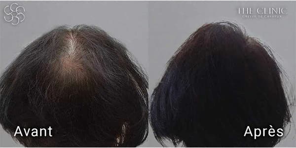hairstetics by the clinic implants capillaires synthetique derrière generation avant apres i alopecie androgenetique femme clinique implants capillaires greffe de cheveux the clinic paris