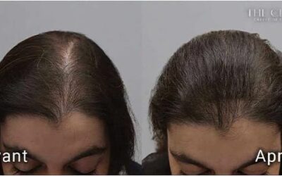 Implants de cheveux synthétiques & alopécie féminine : oui à Hairstetics !