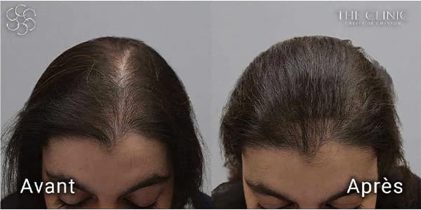 hairstetics by the clinic implants capillaires synthetique derrière generation avant apres k alopecie androgenetique femme clinique implants capillaires greffe de cheveux the clinic paris