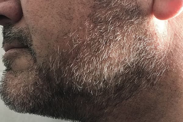implant de barbe avant apres clinique greffe de barbe paris implants capillaires greffe de cheveux the clinic paris