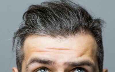 Nécrose après une greffe de cheveux : causes & prévention