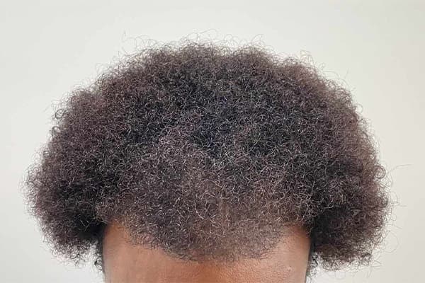 implantation de cheveux afro a punch hybride fue clinique implant capillaire greffe de cheveux robotisee the clinic paris