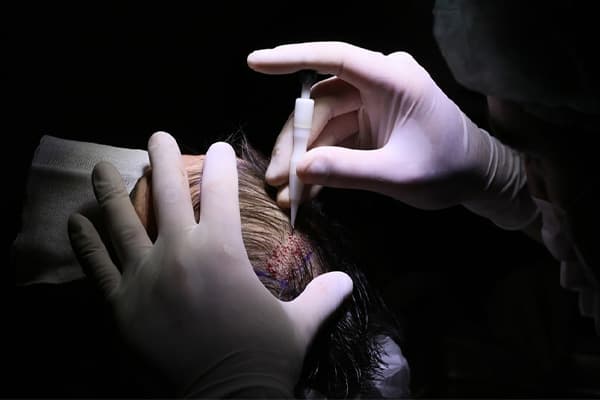 implanteur stylo choi greffe de cheveux robotisee stylo choi clinique implantation capillaire paris implant capillaire greffe de cheveux the clinic paris