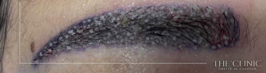 implants sourcils avant apres clinique greffe de sourcils paris implants capillaires greffe de cheveux the clinic paris implants sourcils avant apres clinique greffe de sourcils paris implants capillaires greffe de cheveux the clinic paris