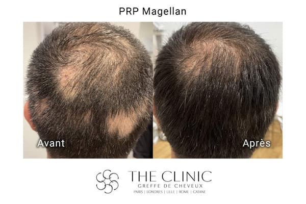 injection prp cheveux maggelan i avant apres clinique greffe de cheveux robotisee paris implants capillaires greffe de cheveux the clinic paris