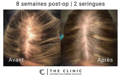 Pourquoi un plan de traitement est-il si important en greffe capillaire ?