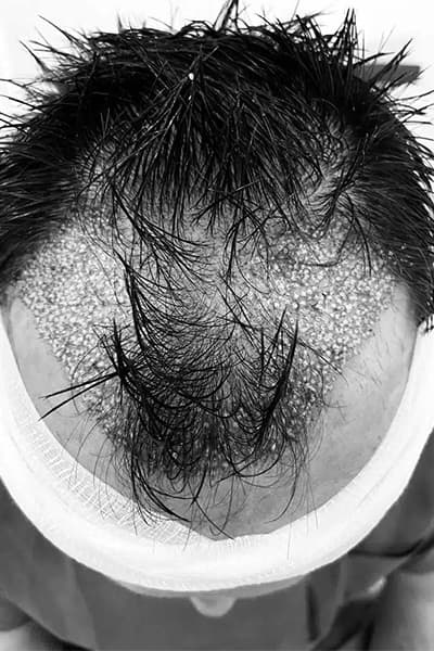 l greffe de cheveux punch hybride by the clinic paris