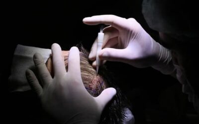 Totalement discrète, découvrez la greffe de cheveux FUE sans rasage