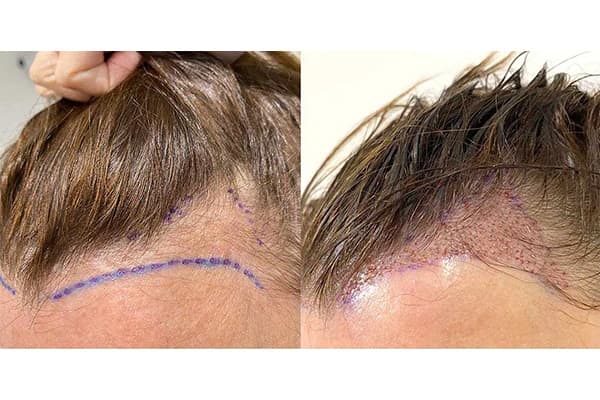 photo i avant apres implants greffons capillaires greffe de cheveux the clinic paris