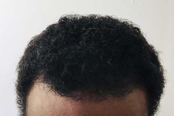 resultat implantation de cheveux afro punch hybride fue homme clinique implant capillaire greffe de cheveux robotisee the clinic paris