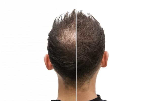 site making artas reimplantation de cheveux assistee par le robot artas clinique implants capillaires the clinic paris site making artas reimplantation de cheveux assistee par le robot artas clinique implants capillaires the clinic paris