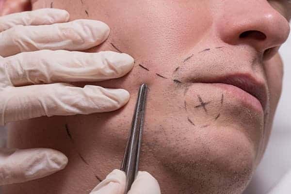 technique implant de barbe clinique greffe de barbe paris implants capillaires greffe de cheveux the clinic paris
